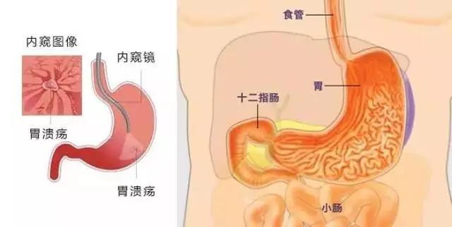 胃镜,肠镜答疑解惑