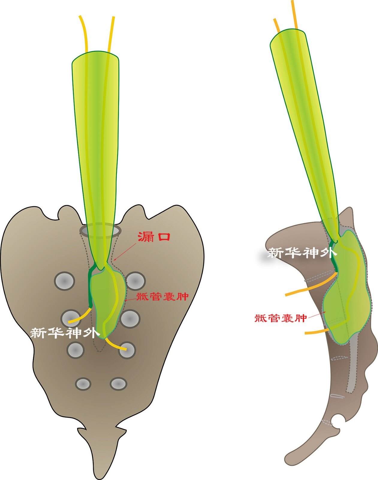 骶管解剖图片