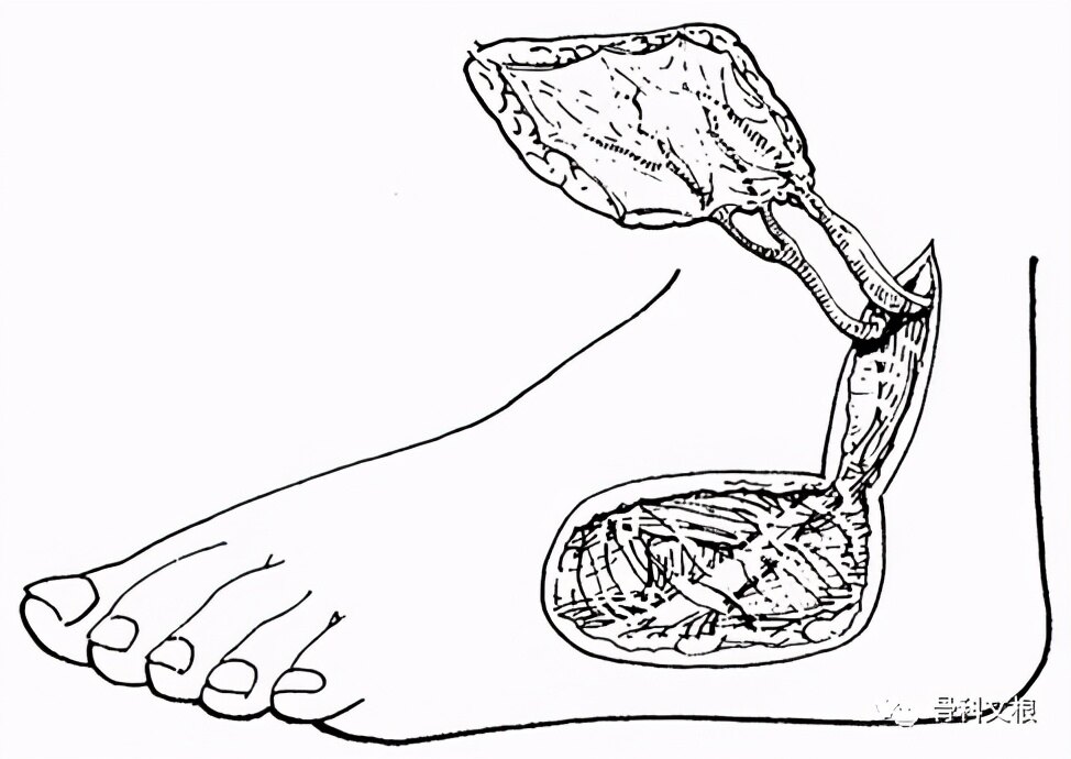 男子严重外伤面临截肢,上海六院文根主任显微手术为其保肢_骨感染病