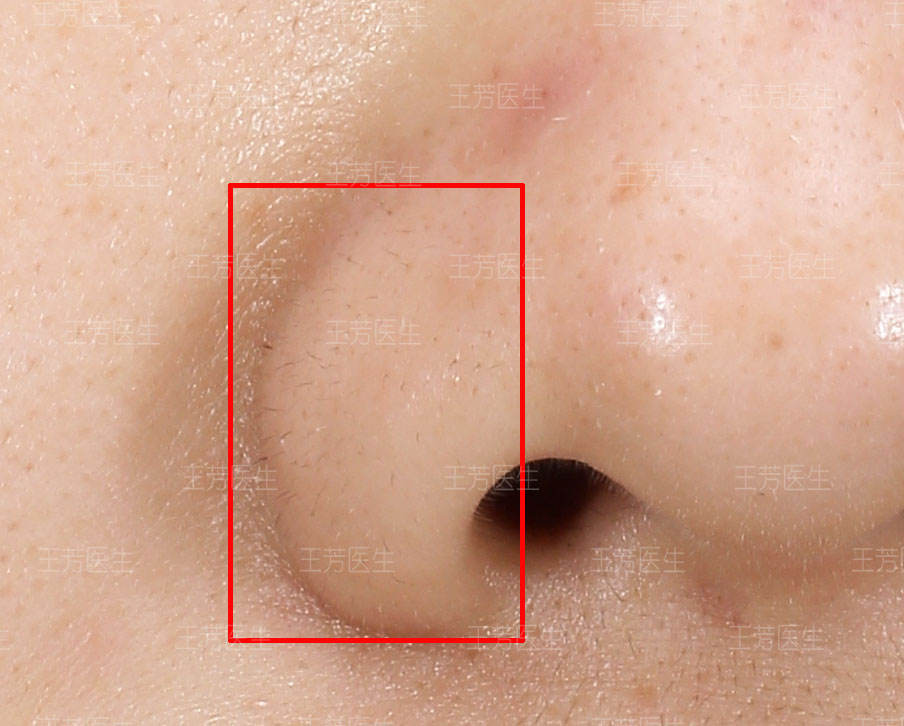 小棘毛壅病鼻子图片图片