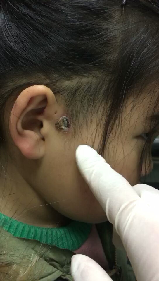 耳前瘘管感染切开引流后伤口长期不愈合