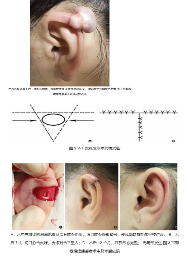 文献阅读 手术切除与术后压力治疗耳廓瘢痕疙瘩 瘢痕疙瘩 瘢痕疙瘩