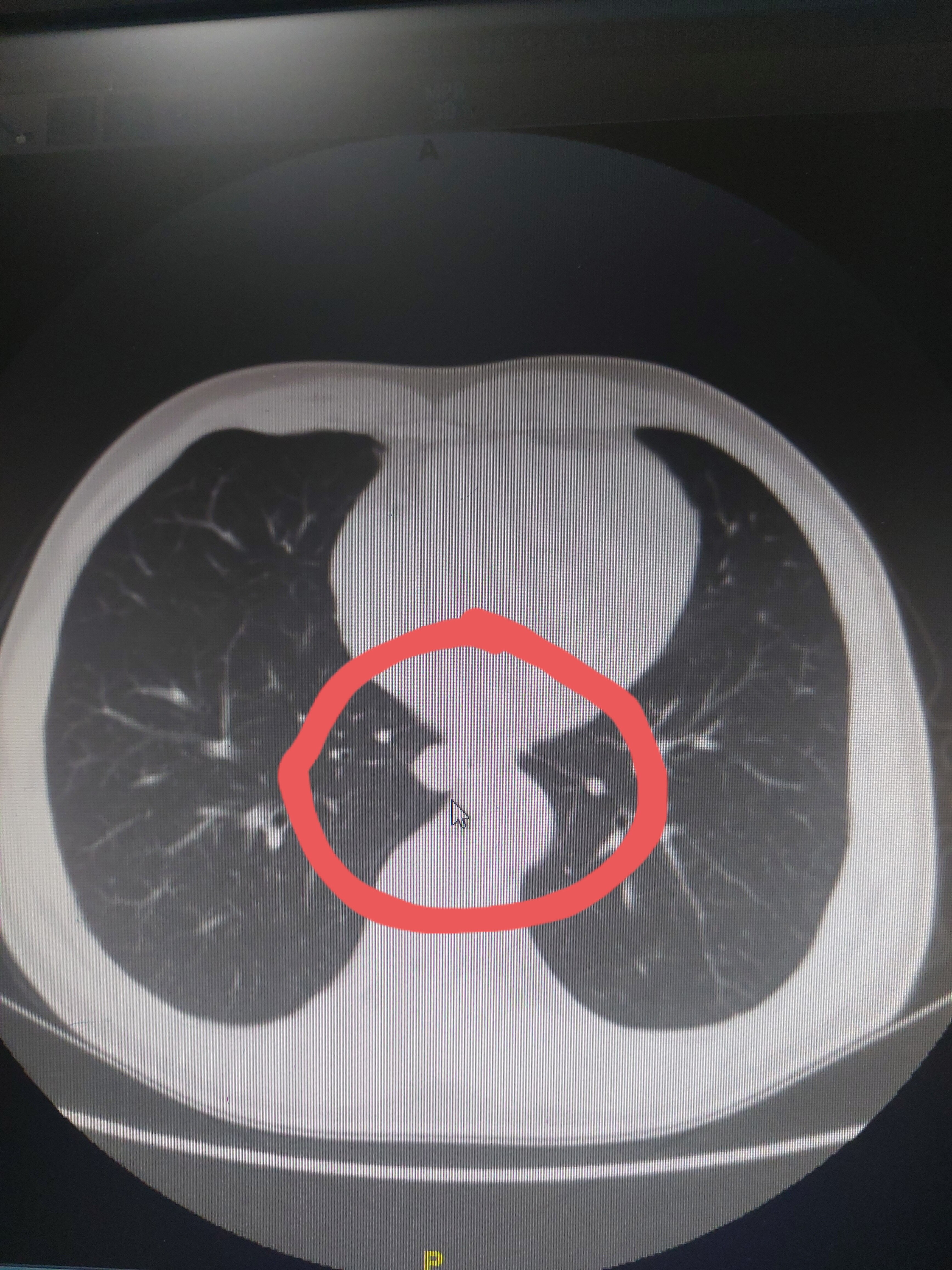 肺癌ct图片 片子图片