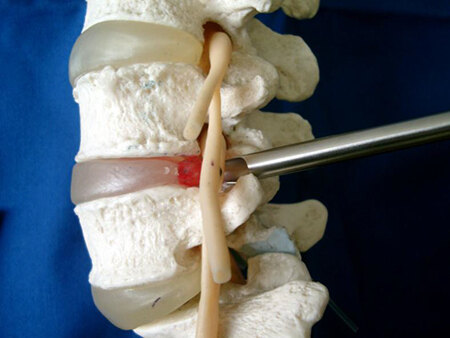 腰间盘突出微创治疗------ 锁孔外科技术(椎间孔镜)_腰椎间盘突出