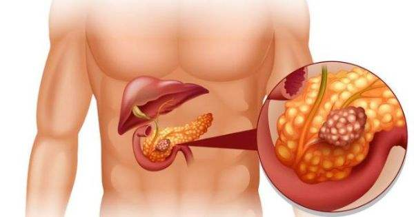 胰腺癌的位置图片图片