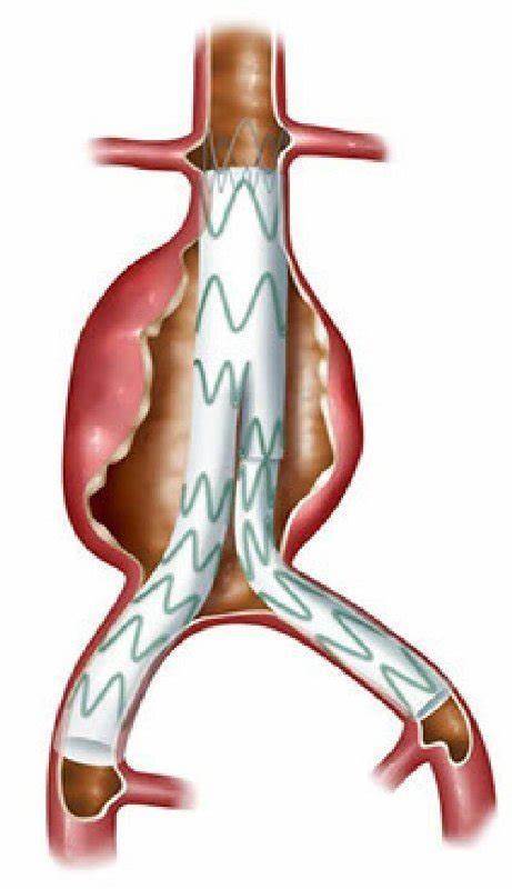 腹主动脉瘤腔内治疗的基本原理是使用带膜的支架型血管隔绝动脉瘤瘤腔