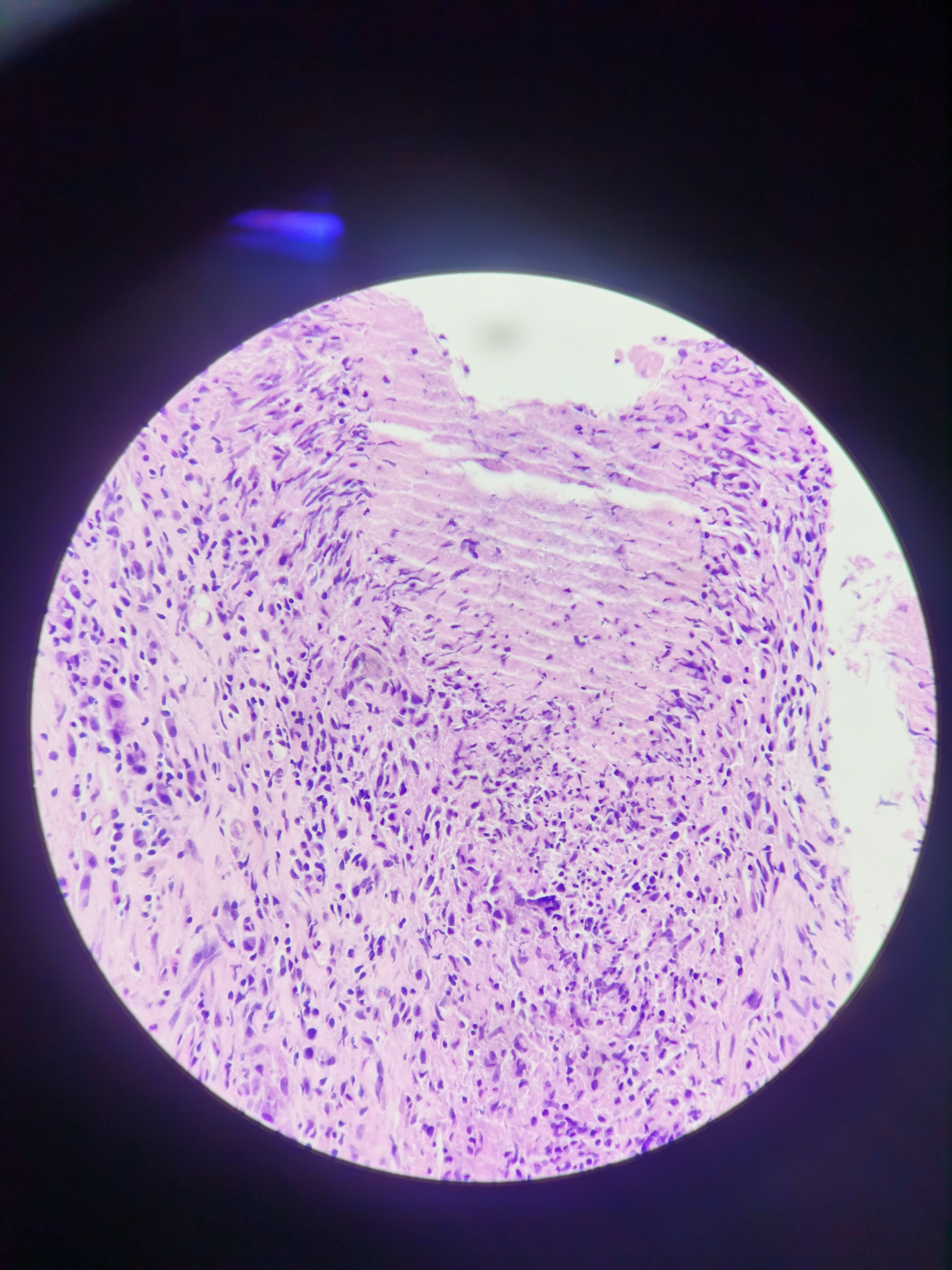 急性髓系白血病,29岁,女性,肝内多发低密度结节,肝组织活检 - 好大夫