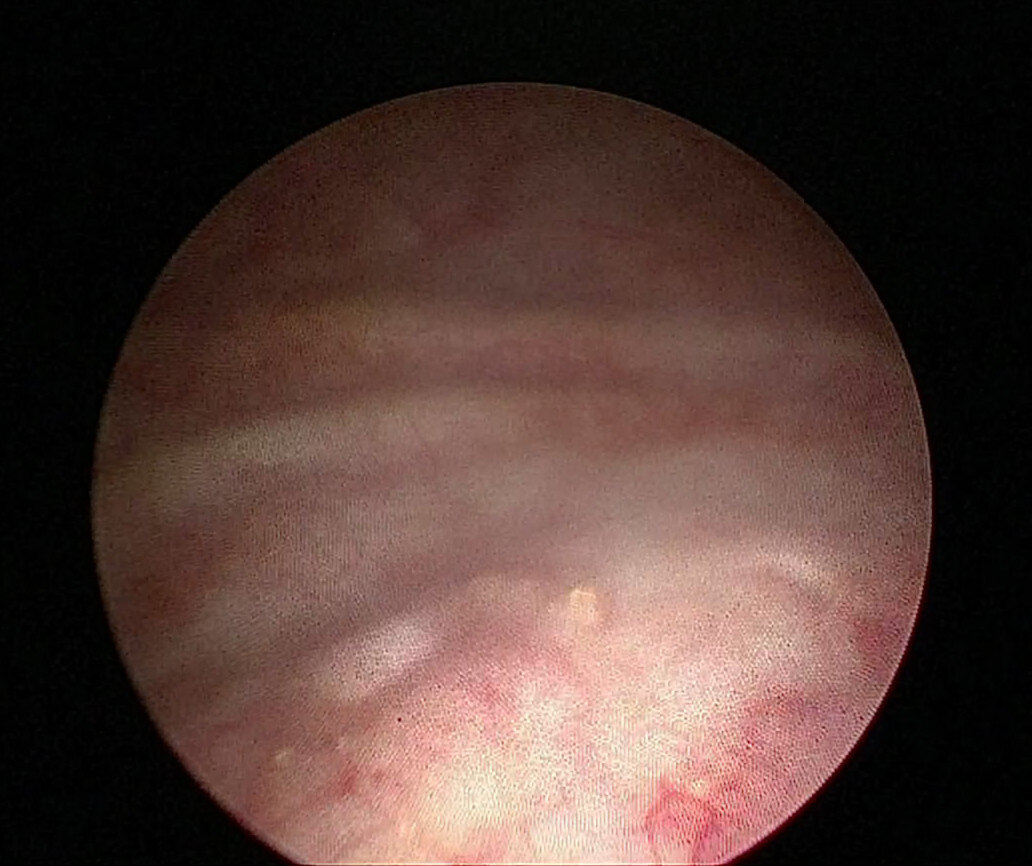 肾输尿管先天性畸形治疗的最新进展(二)_先天性泌尿系畸形_先天性泌尿