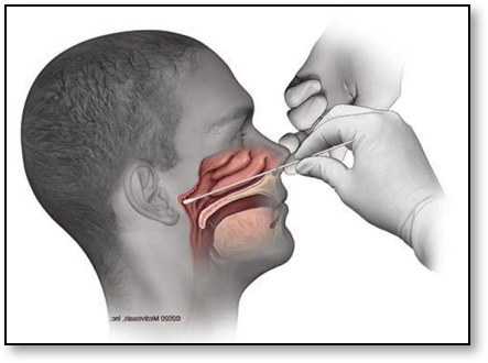 核酸检测插喉示范图图片