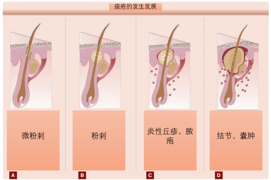 痤疮的发生发展.png