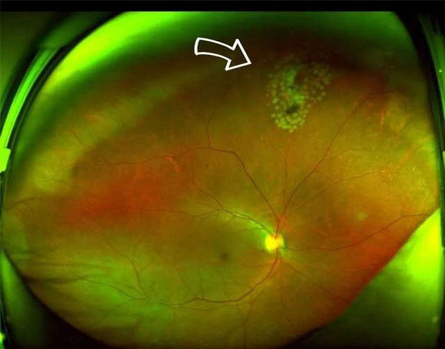 视网膜裂孔激光图片