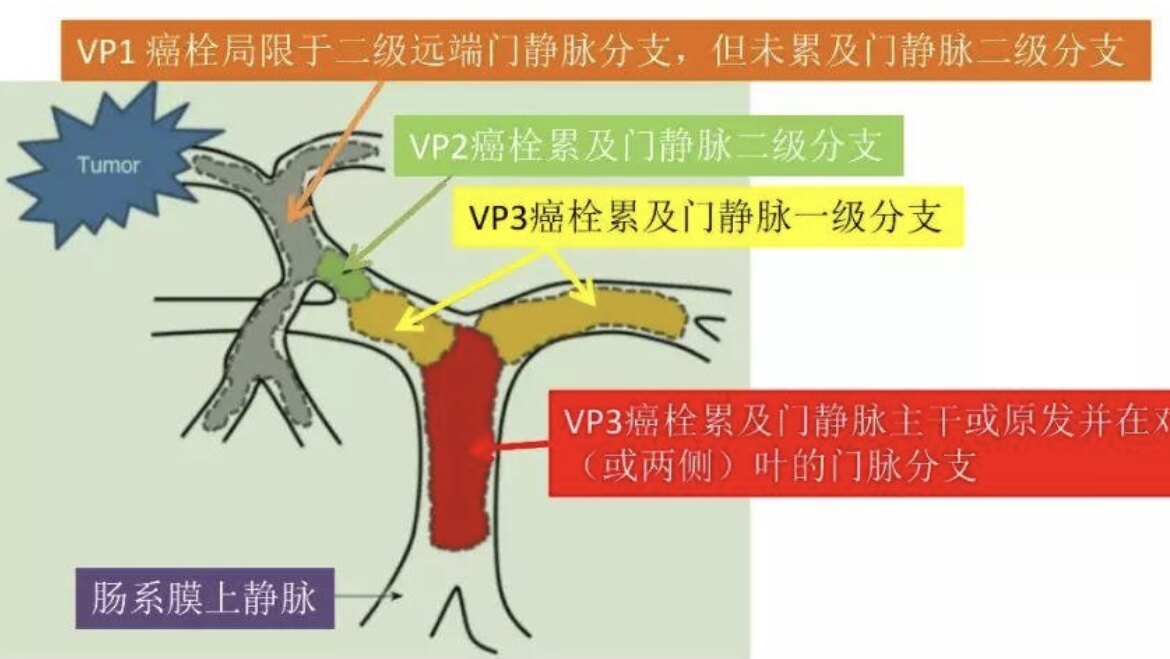 原发性肝癌伴门静脉主干癌栓的临床分型与外科手术治疗的几个关键问题