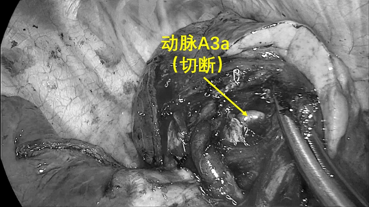 從肺葉切除,到肺段切除,再到聯合亞段切除,體現出胸外科醫生精益求精