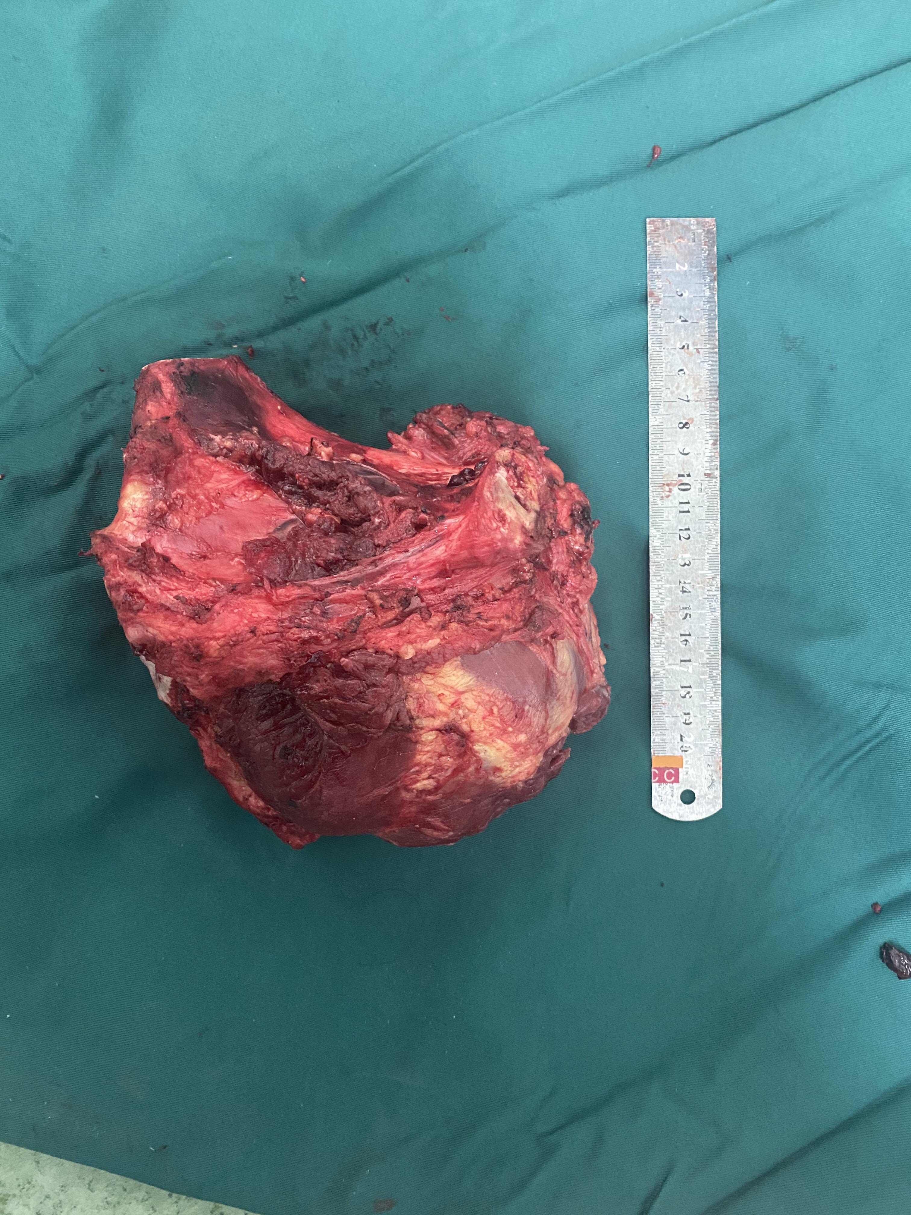 一例复杂骨盆肿瘤的保肢手术治疗 - 好大夫在线