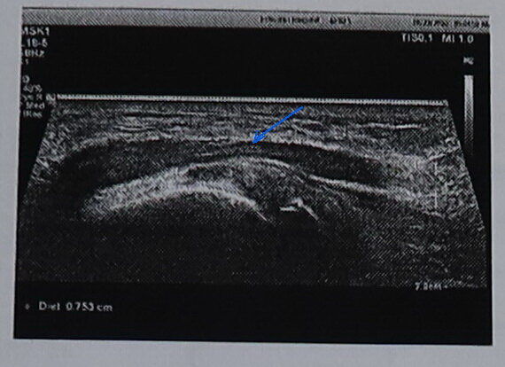 手麻肌萎缩2----肘管综合征的诊断与治疗_肘管综合征_发病原因_症状