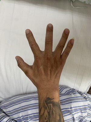 手麻肌萎缩2----肘管综合征的诊断与治疗_肘管综合征_发病原因_症状