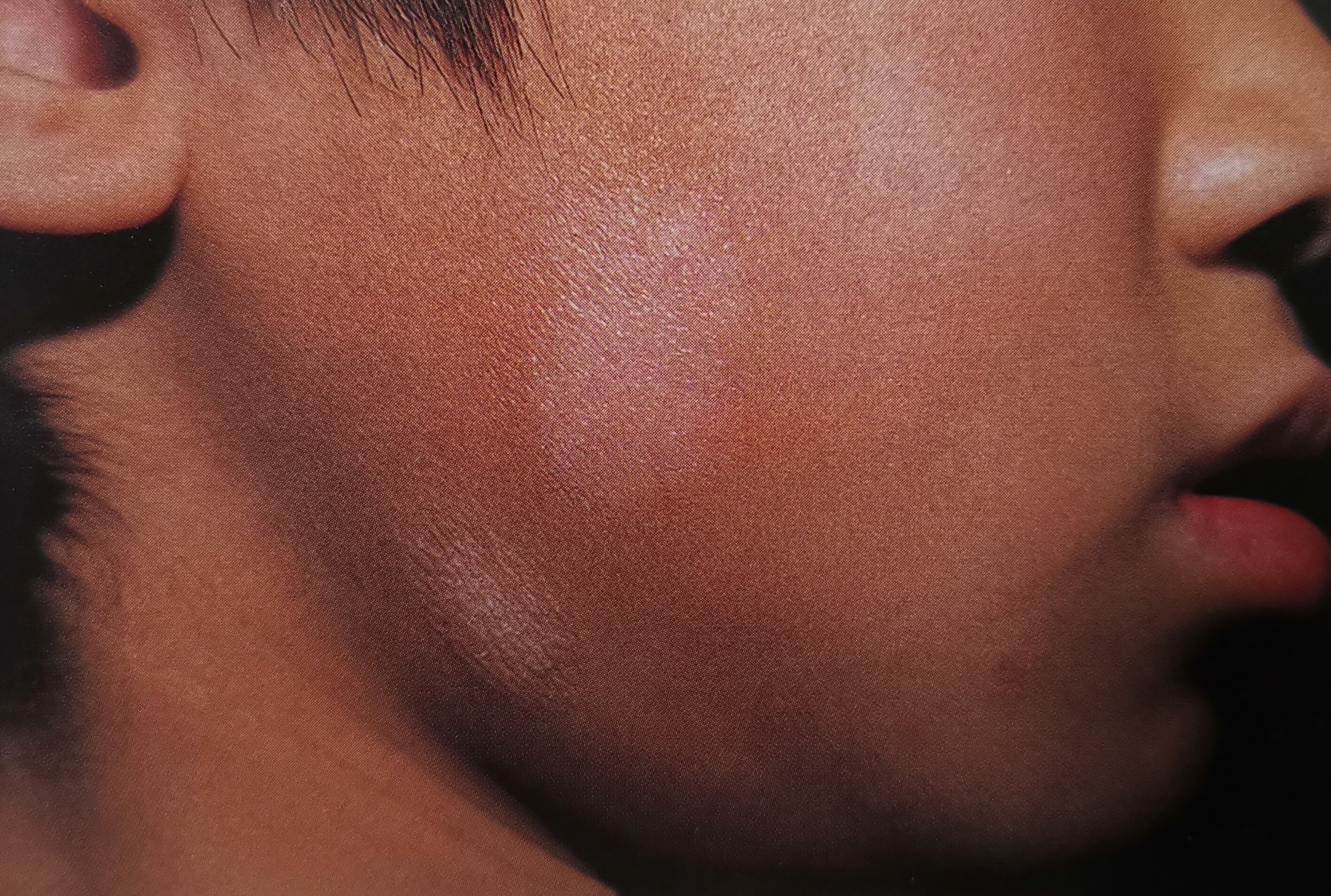 白色糠疹,又名单纯糠疹,俗称虫斑,是以干性细薄糠状鳞屑性色素减退