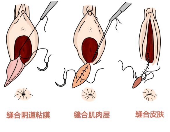 会阴伤口愈合不良,顺产妈妈的难言之痛