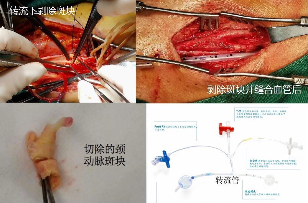 颈动脉狭窄的危害和治疗