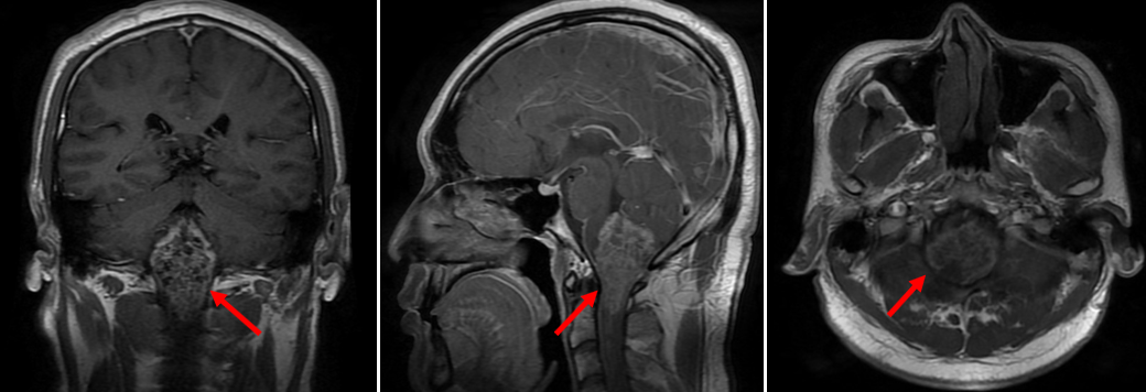 四脑室巨大室管膜瘤手术治疗_室管膜瘤 - 好大夫在线