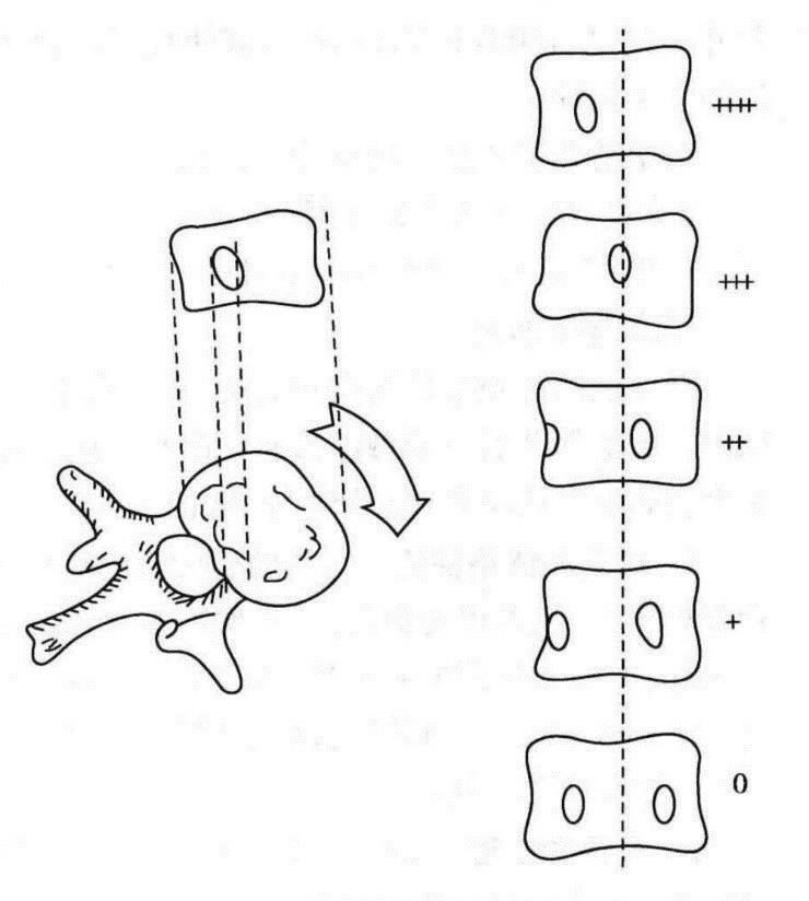 (3)脊柱柔软度侧向屈曲位片牵引下正侧位片(4)脊柱发育成熟度:risser