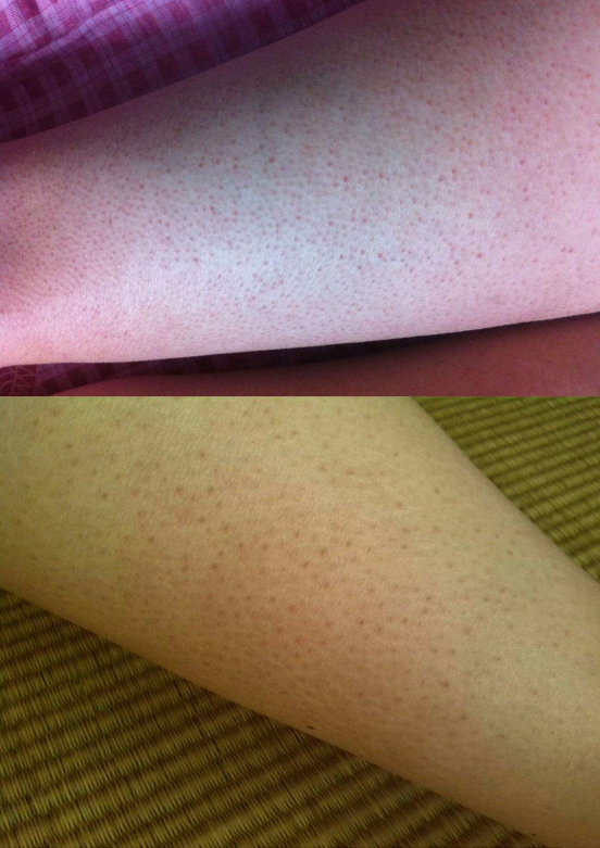 治鸡皮肤改善凸嘴(治鸡皮肤改善凸嘴的药膏) 治鸡皮肤改善凸嘴(治鸡皮肤改善凸嘴的药膏)