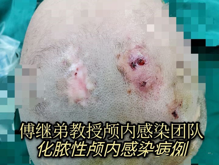 ommaya囊治疗脑积水和颅内感染的弊端_脑积水_脑积水治疗方式 - 好