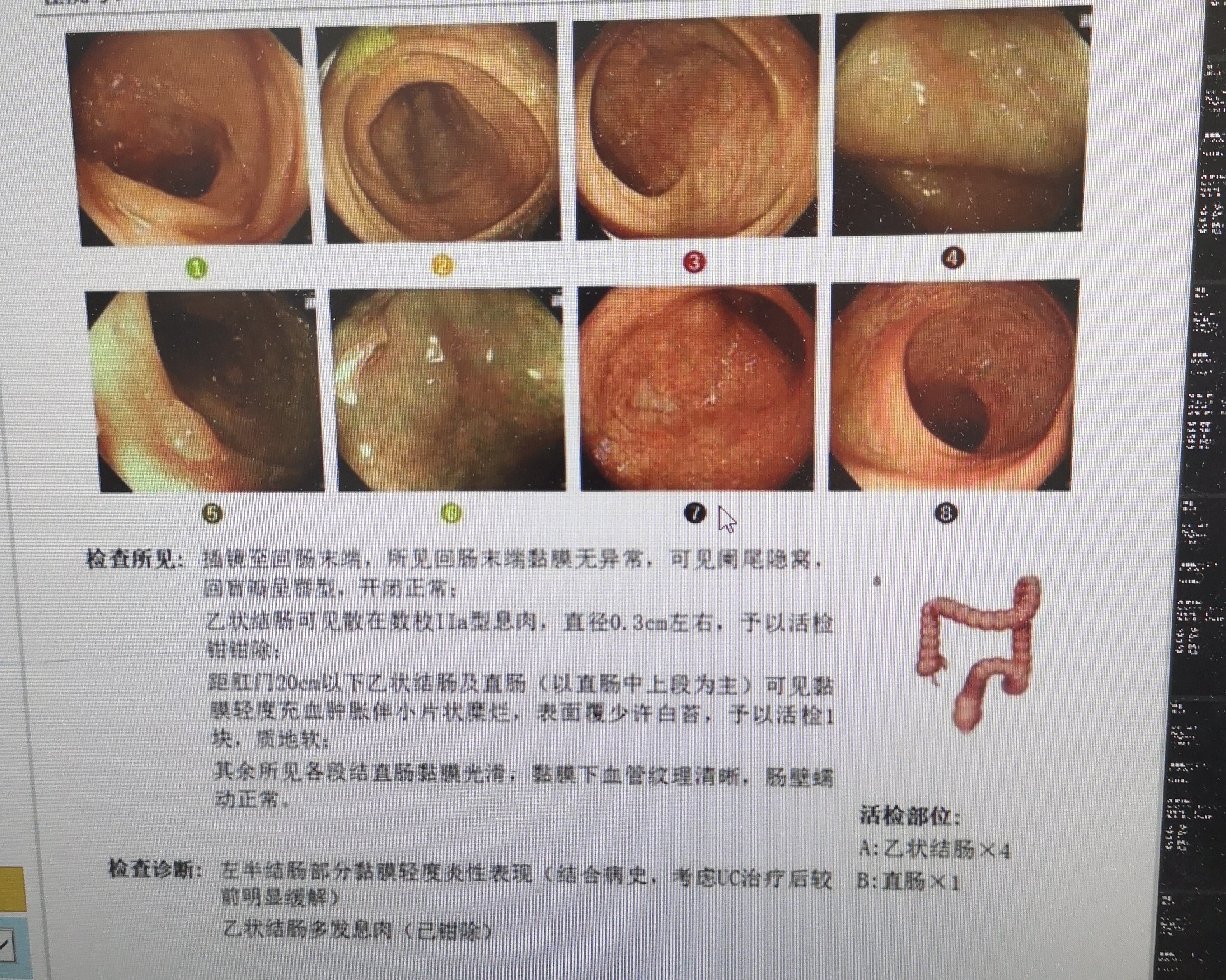 结肠炎照片图图片