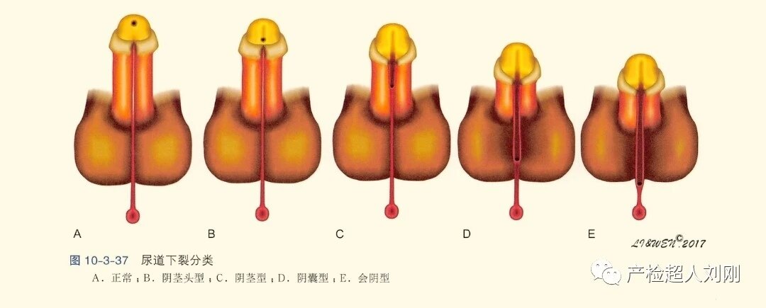 男性尿道下裂图片图片