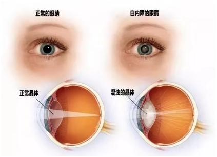 白内障是指眼睛的晶状体由透明变成不透明,阻碍光线进入眼内,从而影响