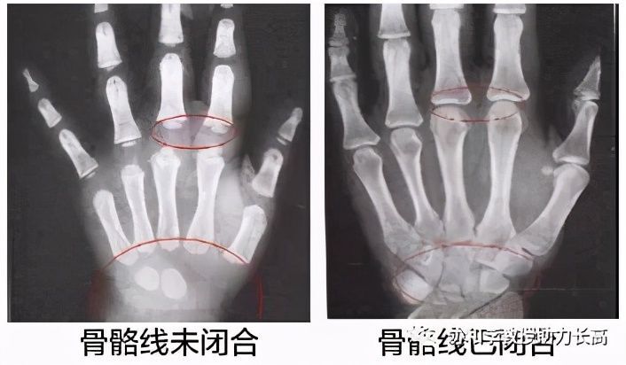 其实是骨骼不断增长的结果,主要是长骨的增长,长骨的最终长度也决定了