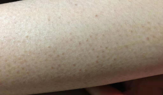 鸡皮肤一捏就疼(鸡皮肤疼是咋回事) 鸡皮肤一捏就疼(鸡皮肤疼是咋回事)