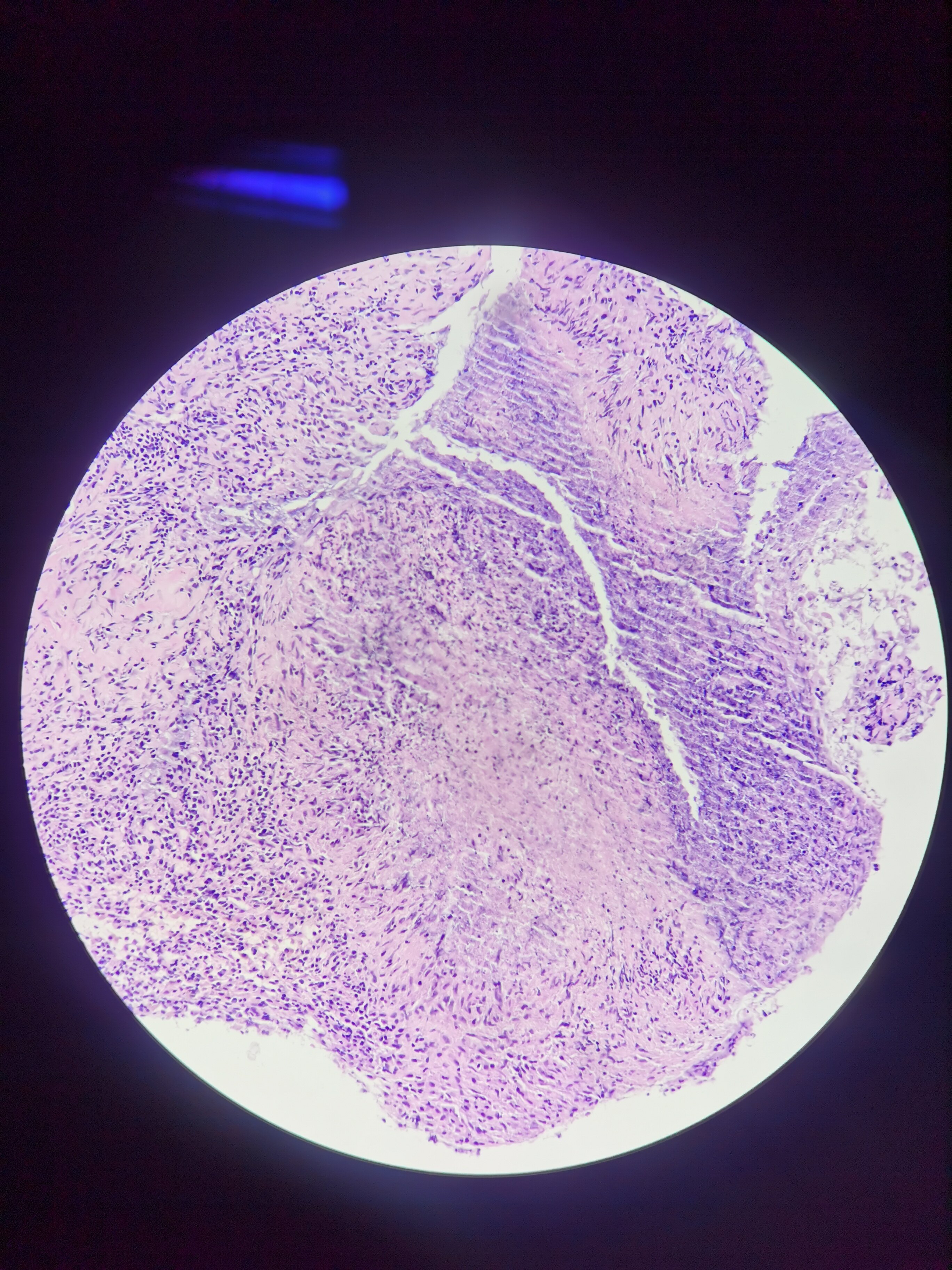 肉芽肿中央见凝固性坏死形态学同时具有肿瘤细胞浸润和肉芽肿性坏死