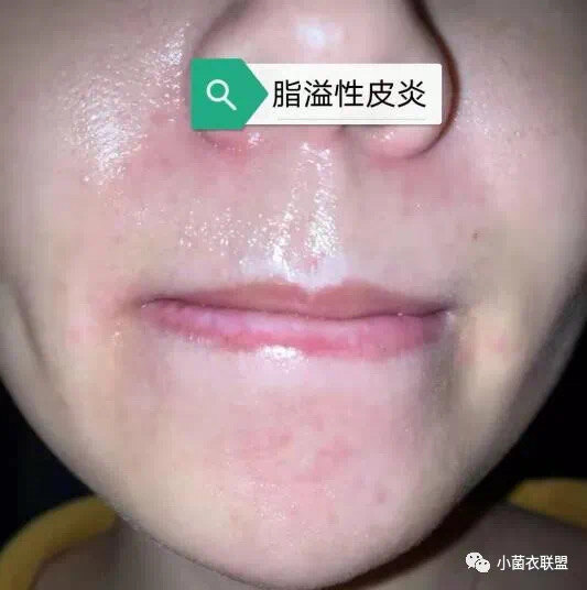 严重脂溢性皮炎怎么治(脂溢性皮炎严重时是什么样了的)