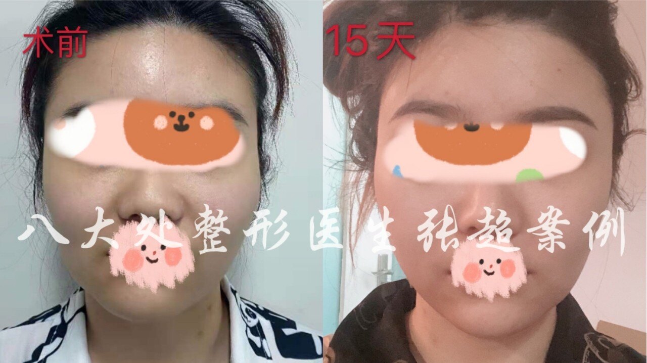 苹果肌可以吸脂吗 吸脂 吸脂 苹果肌可以吸脂吗 吸脂 吸脂