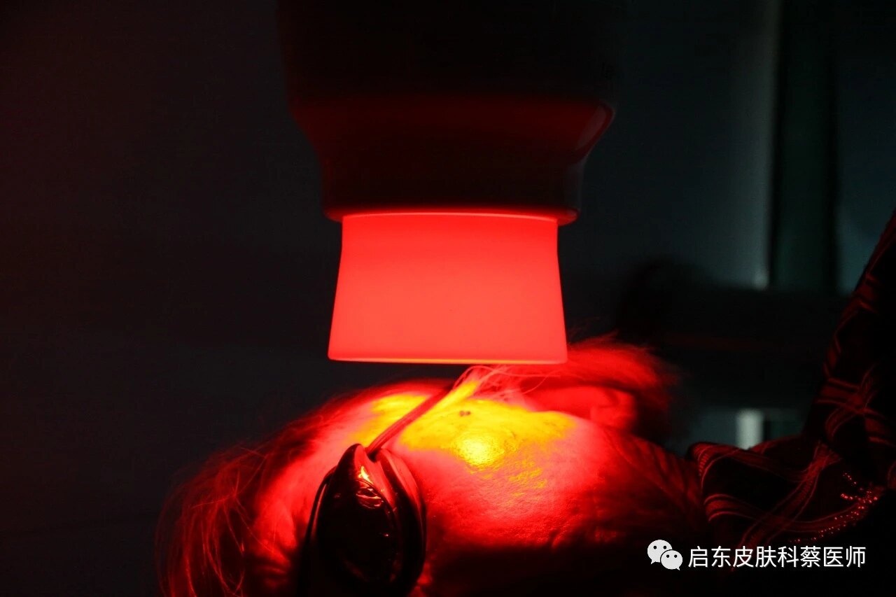 90岁的患者面部scc合并日光性角化一例_皮肤肿瘤_皮肤肿瘤治疗方式