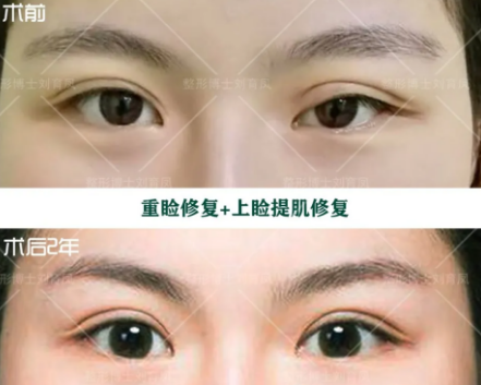 双眼皮修复十问十答 双眼皮修复