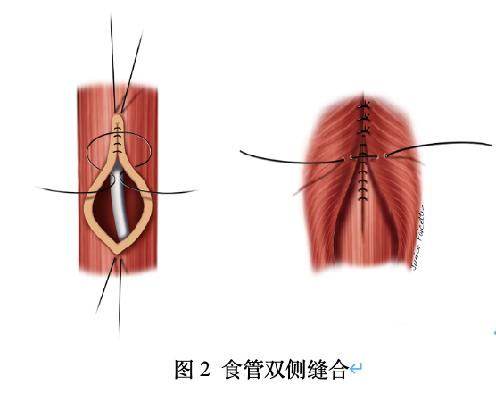 气管食管瘘图片图片