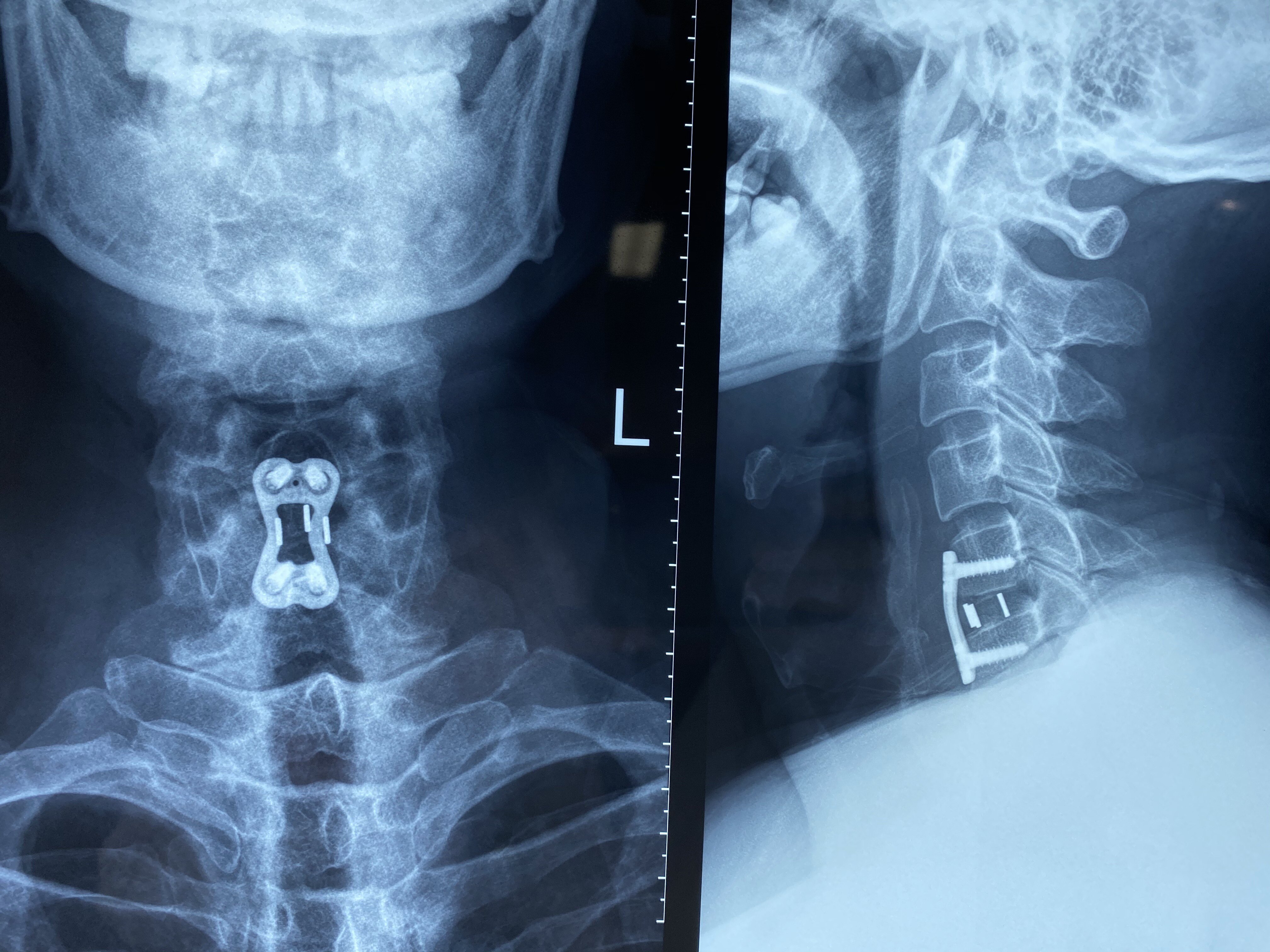 车祸导致的颈椎脊髓损伤的手术过程记录分享 - 病例中心(诊疗助手) - 爱爱医医学网
