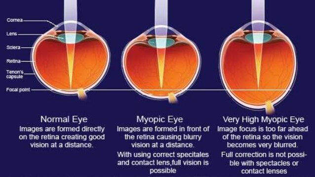 pathological-myopia.jpg