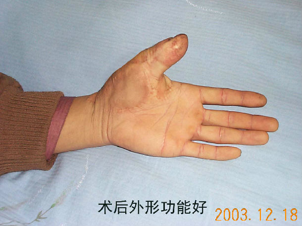 游离拇趾甲皮瓣再造拇指术1 - 好大夫在线
