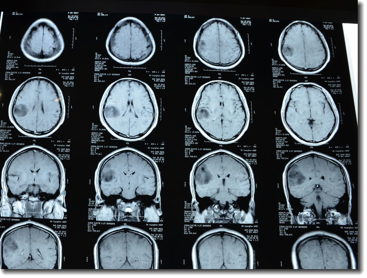 脑胶质瘤的手术和术后放射治疗疗效追踪 - 好大夫在线