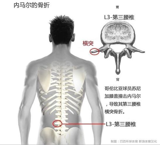 内马尔的骨折与 腰三横突综合症