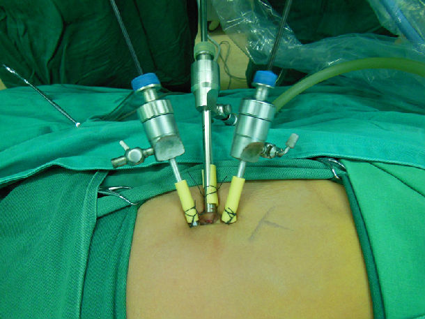 环脐三通道腹腔镜肾盂成形术治疗小儿肾盂输尿管连接部梗阻