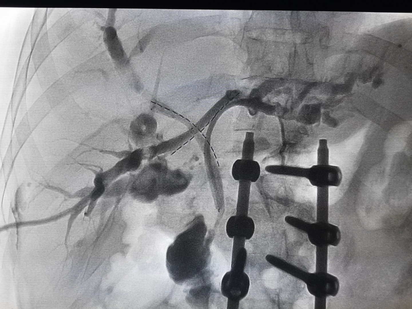胆道支架植入术图片