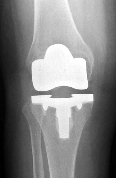 人工膝关节置换术那些事儿 