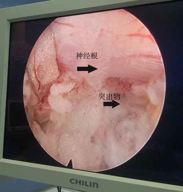 脊柱內鏡下的腰神經根您見過嗎