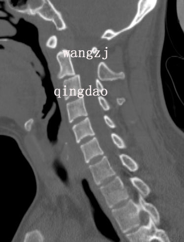 枢椎椎弓骨折图片