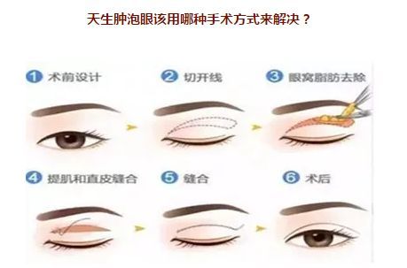 怎么翻上眼皮 0oYBAF1FKkyANH6lAABEAopIXs0386.jpg?_ms_=2753