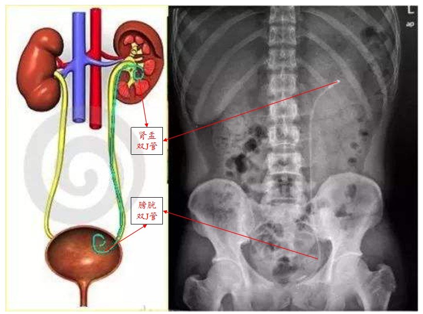 肾结石手术双j管图片图片